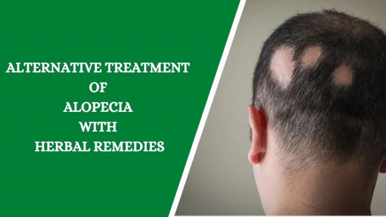 Alternative Treatment of Alopecia with Herbal Remedies