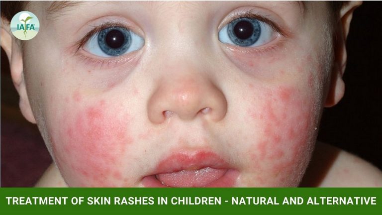 Treatment of Skin Rashes in Children - Natural and Alternative