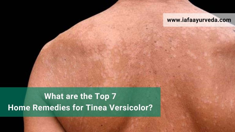 What are the Top 7 Home Remedies for Tinea Versicolor?