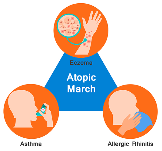 Concept of Atopic March