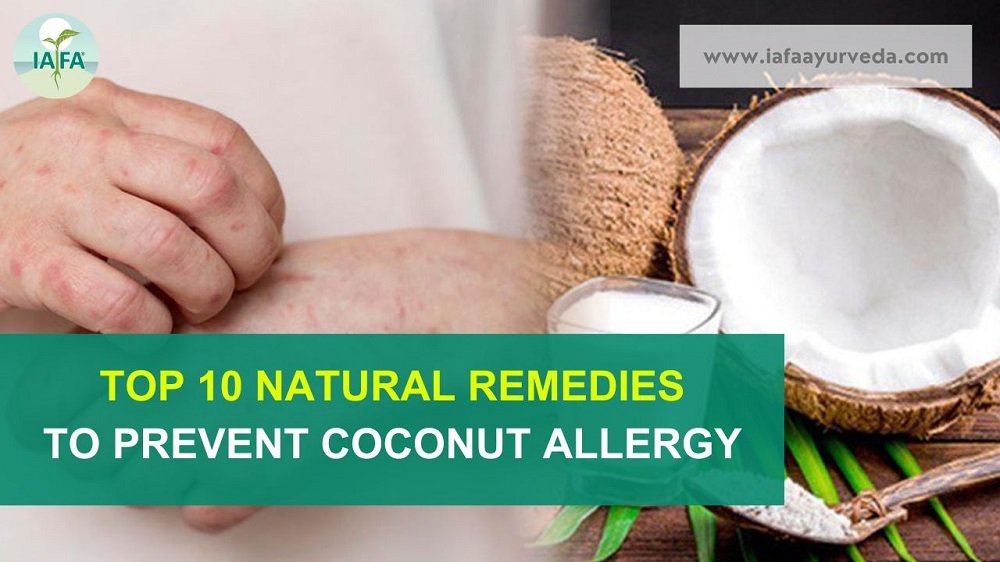 Top 10 Natural Remedies to Prevent Coconut Allergy